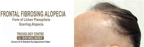 What is Frontal Fibrosing Alopecia? TRICHOLOGY CENTRE | Toronto