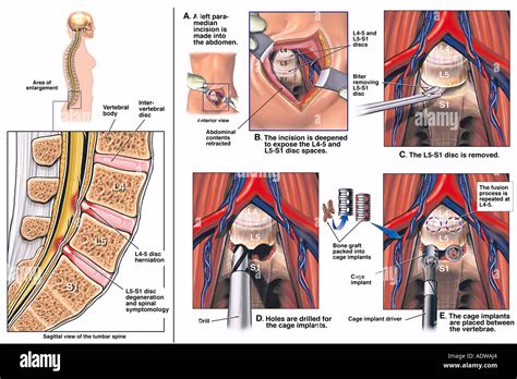 Spine Surgery L4 5 and L5 S1 Anterior Lumbar Spinal Fusion Procedure ...