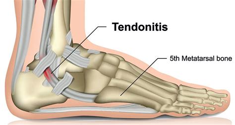 Peroneal Tendonitis (Tendinopathy) - Symptoms, Causes & Treatment