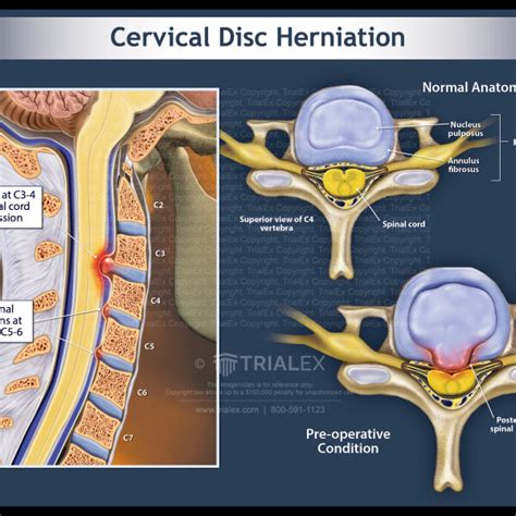 Herniated Cervical Disc Diagram