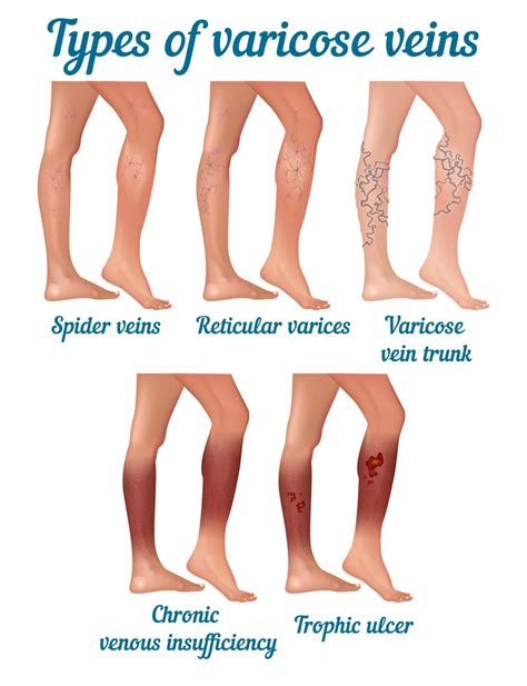 Varicose Veins Laser Treatment Cost Online Clearance, Save 43% | jlcatj ...