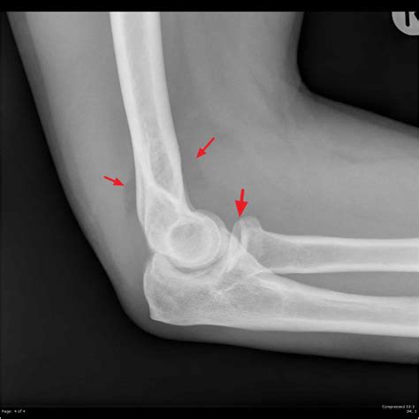 Radial head fracture causes, types, symptoms, diagnosis, treatment ...