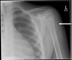 Humerus Fracture X Ray