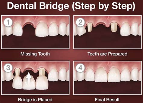 Dental Bridge - Procedure, Dental Bridge Vs Dental Implant