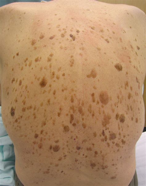 Seborrheic Keratosis or Old Age Spots | by Stephen Sovie | Your Voice ...