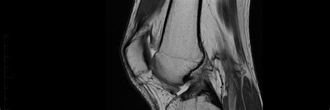 MRI Scan of Knee - Melbourne Radiology Clinic - MRI at Melbourne ...