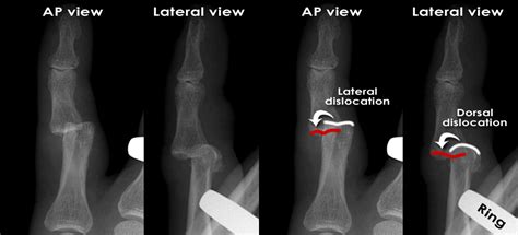 Introduction to Trauma X-ray - Dislocation injury