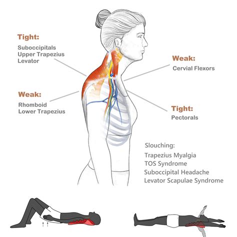 Trapezius Muscle Pain | ubicaciondepersonas.cdmx.gob.mx