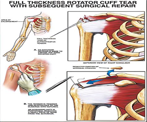 Rotatorcuffinjurysymptoms