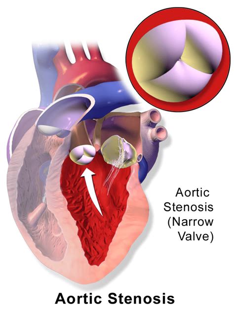 Difference Between Mitral Valve and Aortic Valve | Compare the ...