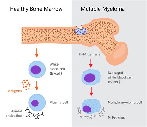 Physiotherapy in Multiple Myeloma Treatment