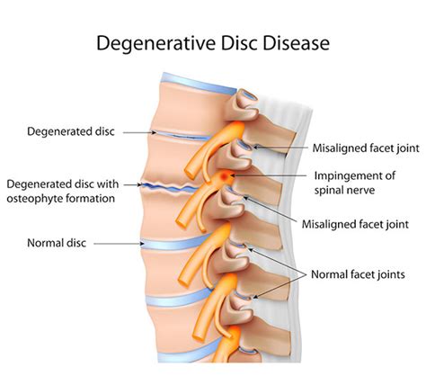 Low Back Pain | Facet Joint Syndrome | Facet Lock