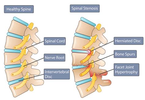 Lumbar Spinal Stenosis | Columbia Orthopaedic Group