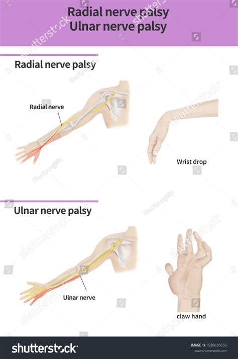 Radial Nerve Palsy Symptoms