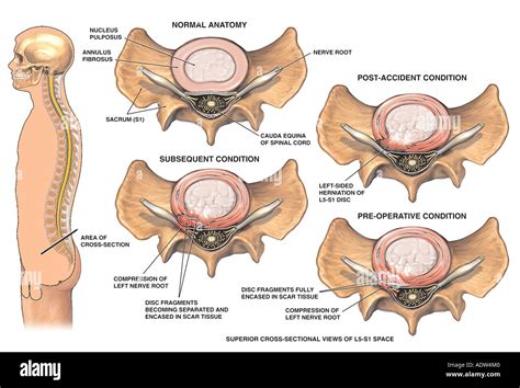 L5-S1 Disc Herniation Progression - Superior View Stock Photo: 7711807 ...