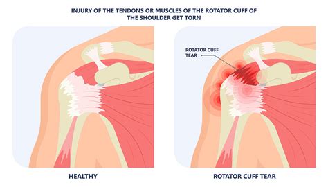 Rotator Cuff Injury: 7 Signs and Effective Care | Vejthani