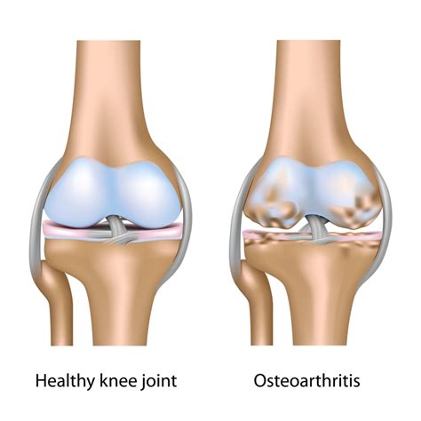 Osteoarthritis