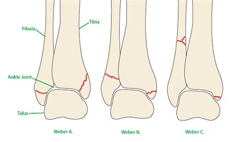 Ankle Fracture - Orthoanswer