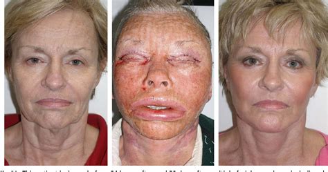 Complications in facelift surgery and their prevention. | Semantic Scholar