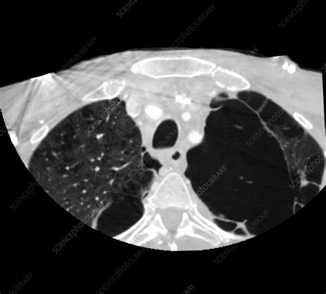 Emphysema, X-ray - Stock Image - C039/4120 - Science Photo Library