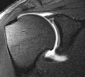 SLAP / Labral Tear - University of Toronto Orthopaedic Sports Medicine ...