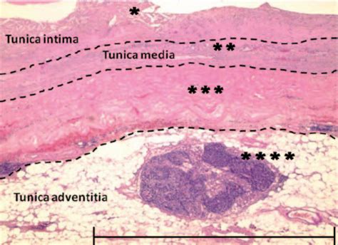 Aortic Dissection Histology