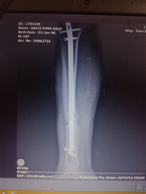 Tibia Fibula Fracture Treatment | Tibia Fibula Bone Surgery