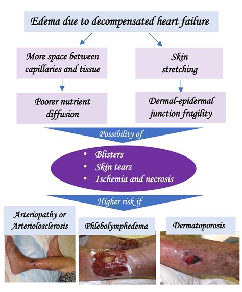 Leg ulcers due to heart failure? - Elena Conde