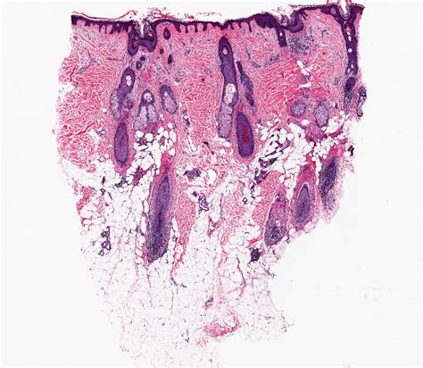 Scarring Alopecia Histology