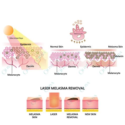 Melasma Treatment – Purple Face