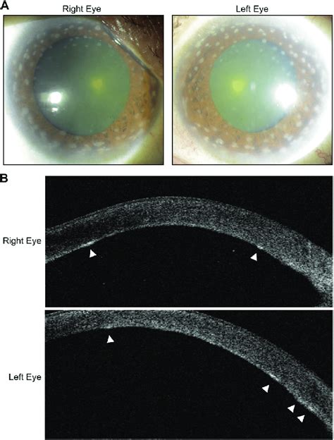 Macular corneal dystrophy associated with peripheral Descemet membrane ...