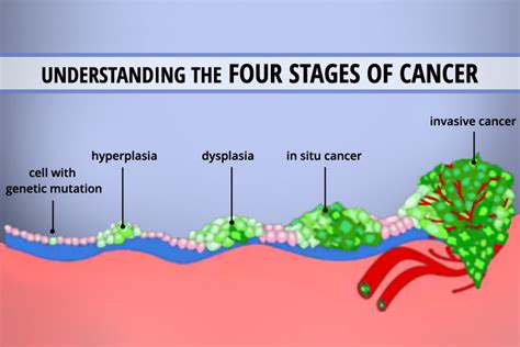 Understanding the 4 Stages of Cancer