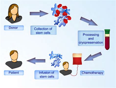 Allogeneic stem cell transplantation. Hematopoietic stem cells are ...