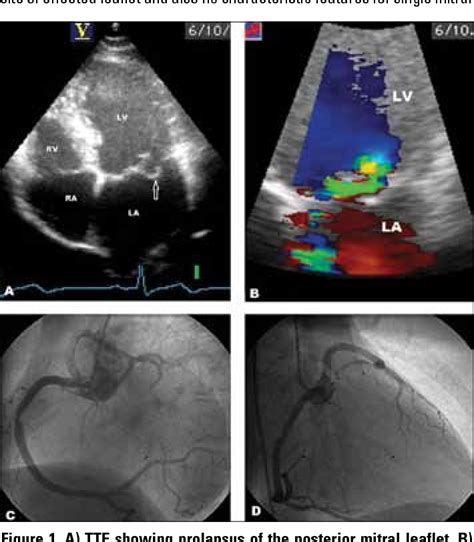 Anterior aortic sinus | Semantic Scholar