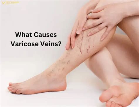 What Causes Varicose Veins? Treatment, Risk Factors, Prevention