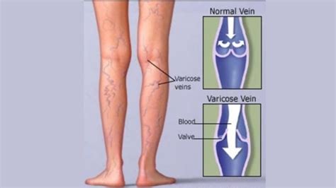 Varicose Veins – Causes, Symptoms, Treatment | Medintu