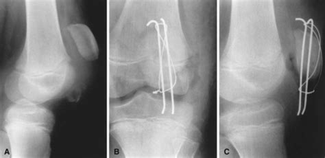 Patella Sleeve Fracture - Pediatrics - Orthobullets