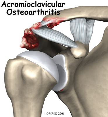 AC Joint Arthritis Causes, Symptoms & Treatment | Dr Kaushik