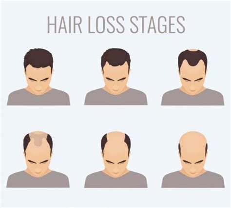 Stages Of Receding Hairline