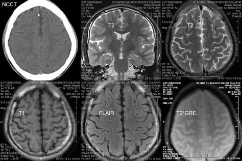 Dr Balaji Anvekar FRCR: Calcified Granuloma CT vs MRI Brain