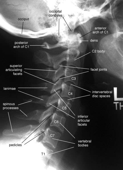 Radiographic Anatomy of the Skeleton: Cervical Spine -- Lateral View ...