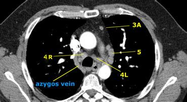 The Radiology Assistant : Mediastinum - Lymph Node Map