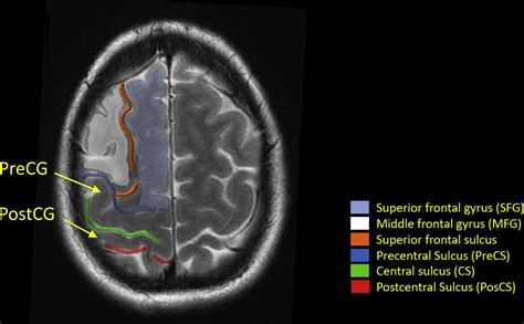 Brain Lobe Anatomy Mri