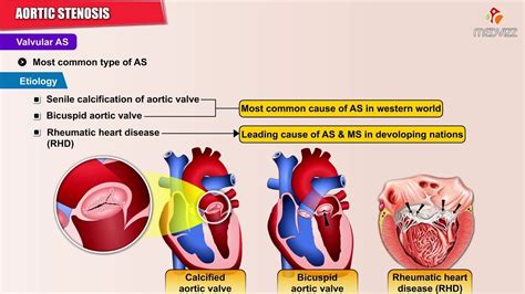 Aortic Stenosis Stages