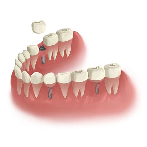 Wisdom Tooth Extraction | What to Expect After Wisdom Tooth Removal