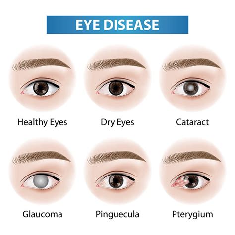 Eye Diseases