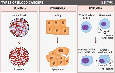 Blood Cancer- Types, Symptoms, Causes and its Treatment