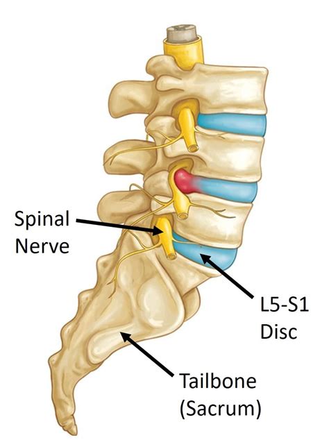 L5 S1 Disc Degeneration Symptoms