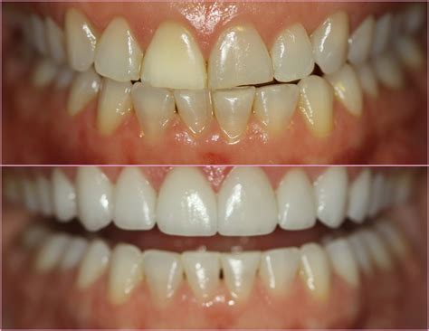 Porcelain Veneers Chicago ~ Before and After ~ July Case of the Month ...