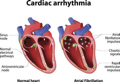 Afib | What is Afib | Afib Treatment | Afib Symptoms | Atrial ...